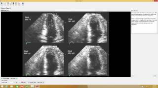 6 Echo Test and Teach Stress Echo Case [upl. by Dunkin]