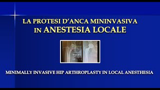 La protesi danca mininvasiva in anestesia locale  Minimally Hip Arthroplasty in Local Anesthesia [upl. by Naellij]