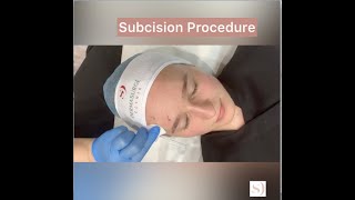 Complete subcision surgery procedure at Dermasurge Clinic [upl. by Adalie917]