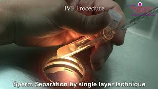 IVF Procedure [upl. by Byler]