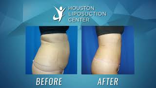 Liposuction for Women  Liposuction Before amp After [upl. by Annawek828]