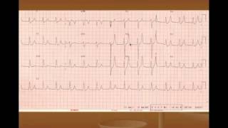 Hyperkalemia Treatment and ECG Changes [upl. by Collimore]