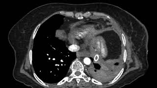 TMT XRAY CHEST LEFT OPAQUE HEMITHORAX [upl. by Maillij]