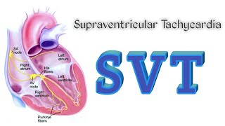 ABLATION for ATRIAL FIBRILLATION Watch a live procedure [upl. by Cleodal]