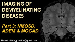 Imaging of demyelinating disorders part 3  NMOSD MOGAD and ADEM [upl. by Ellerey]