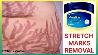 How to Get Rid of Stretch Marks Fast Using Vaseline Petroleum Jelly at HOME [upl. by Etra378]