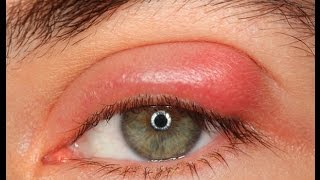 Blepharitis red swollen eyelids Causes Symptoms Treatments [upl. by Clova96]