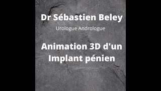 Dr Sébastien Beley Implant Pénien Animation 3D dun Implant pénien avec commentaires [upl. by Llij]