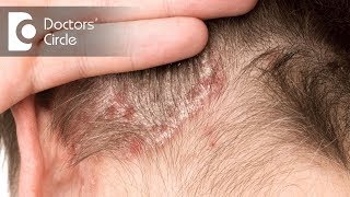 Treatment options for Scalp Psoriasis  Dr Rashmi Ravindra [upl. by Elenore]