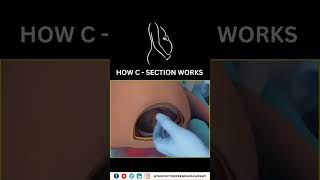 Cesarean Section Explained Why Doctors Choose CSections for a Safer Birth 👶✂️ Cesarean Birth [upl. by Nattie]