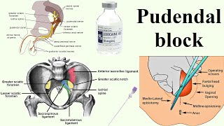 pudendal block [upl. by Odranreb]