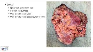 Kidney Renal cell carcinoma Microscopy  Talking slide [upl. by Jennifer607]