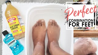 Listerine Foot Soak  Is It Effective  Listerine And Vinegar Foot Soak  Listerine Foot Bath [upl. by Milly]