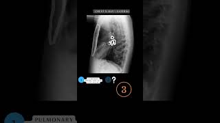 Chest Xray Anatomy Quiz Questions and Answers  Chest Xray Anatomy xray respiratory shorts [upl. by Clywd]