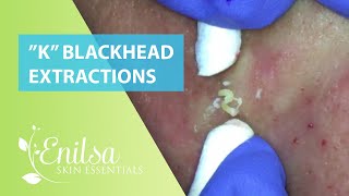 Blackheads Extractions “K’s” 8th Treatment [upl. by Shellie]