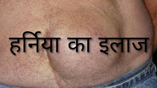 हर्निया क्या है  Hernia in Hindi [upl. by Eillom862]