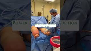 Lipedema Surgery  Liposuction for Lipedema Before amp After  Dr Boris Volshteyn [upl. by Shaya532]