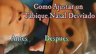 Tabique Nasal DesviadoSíntomas Ajuste CorrecciónManipulacion TratamientoQuiropractico Roncar [upl. by Initirb426]