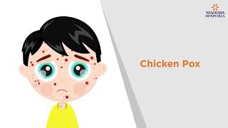 Chicken Pox Symptoms Causes Prevention and Treatment  Yashoda Hospitals [upl. by Enitsyrhc]