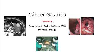 Cáncer Gástrico Tratamiento y Pronóstico [upl. by Marler]