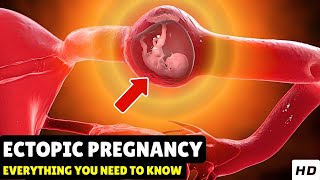 Ectopic Pregnancy – Causes Signs and Symptoms Diagnosis amp Treatment [upl. by Mirella]