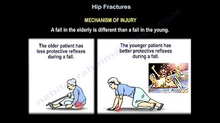 Hip Fractures Mechanism Of Injury  Everything You Need To Know  Dr Nabil Ebraheim [upl. by Mehalick837]