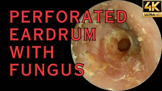 Perforated Eardrum With Recurrent Infection 4K 60FPS [upl. by Alesandrini596]