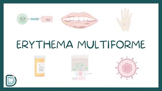 Erythema Multiforme EM Causes Diagnosis Types and Management [upl. by Nottap]