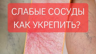 ХРУПКИЕ И СЛАБЫЕ СОСУДЫ КАК УКРЕПИТЬ [upl. by Tullius]