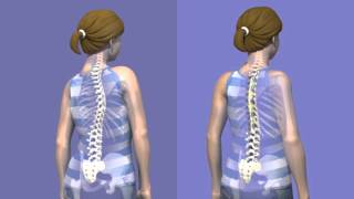 What is Scoliosis surgery [upl. by Tati]