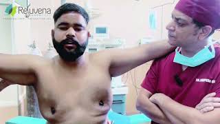 Gynecomastia Surgery Review No Pain amp Affordable Cost at Rejuvena Cosmo Care  Dr Deepesh Goyal [upl. by Aivilys556]