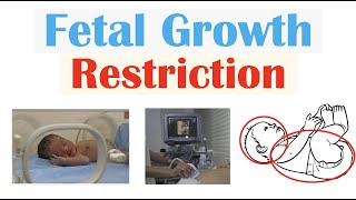 Fetal Growth Restriction FGR IUGR  Types Causes TORCH Infections Diagnosis Treatment [upl. by Anairad]