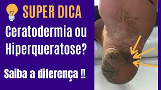 Ceratodermia ou Hiperqueratose Saiba a diferença [upl. by Amsirp875]