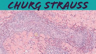 ChurgStrauss syndrome eosinophilic granulomatosis with polyangiitis EGPA vasculitis pathology [upl. by Elynad16]