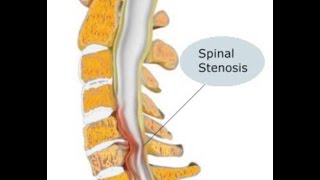 Estenosis Espinal [upl. by Friedman]