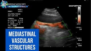 BronchAtlas EBUS and Suspected Pulmonary Embolism [upl. by Amelita431]