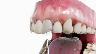 Guide to Front Tooth Chipped Filling Mastery [upl. by Anial]