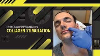 Sculptra Injections for Facial Sculpting  Collagen Stimulation  Dr Jason Emer  LIVE [upl. by Paten963]