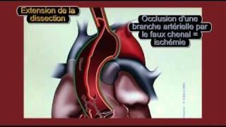 Physiopathologie de la dissection aortique [upl. by Tripp]