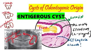 Dentigerous cyst  HISTOPATHOLOGY Clinical  etiopathology DETAILED  Cysts of odontogenic origin [upl. by Eniotna981]