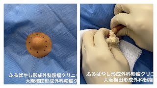 顔の粉瘤 ブログでも詳しく解説してます。くりぬき法 ふるばやし形成外科粉瘤クリニック 東京新宿院 大阪梅田形成外科クリニック [upl. by Marrissa]