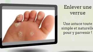 Enlever une verrue  Mon astuce simple et efficace pour y arriver [upl. by Nyltiak]