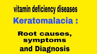 Keratomalacia Vitamin deficiency diseases [upl. by Anuahsal]