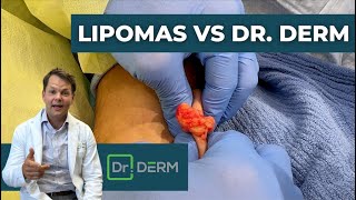 Lipomas vs Dr Derm  Dr Derm [upl. by Nadaha262]