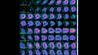 Ateromatosis e infartos Dr Huge Stat [upl. by Strait84]