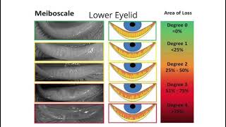 Eyedeology Eye School What is Meibomian Gland Dysfunction MGD [upl. by Lyckman]