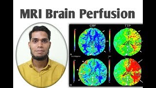 MRI Brain perfusion [upl. by Namyw]