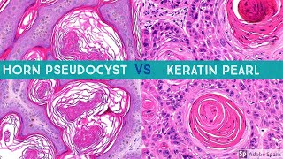 Keratin Pearl SCC vs Horn Pseudocyst SK aka quotpseudohorn cystquot [upl. by Enilada930]