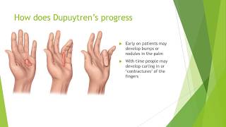 Dupuytrens Contracture Treatment  Everything You Need to Know [upl. by Neeleuqcaj]