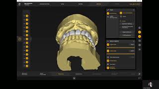 inLab SW22 Complete over Natural Dentures [upl. by Horbal]